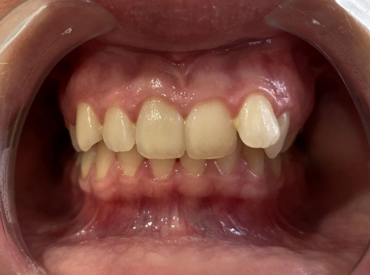 ClearCorrect kezelés - 48 sínpár - 21 hónap kezelési idő