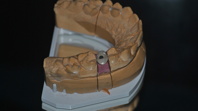 Szóló csavaros korna implantátumra